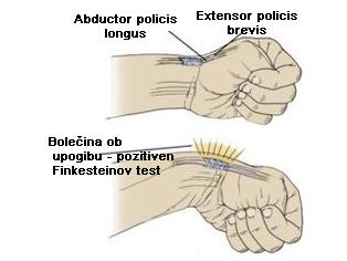 de Quervainova bolezen